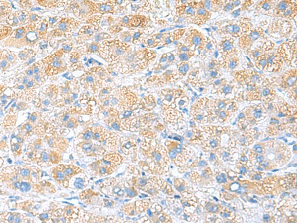 Immunohistochemistry of paraffin-embedded Human liver cancer tissue using RPS16 Polyclonal Antibody at dilution of 1:65(×200)