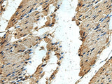 Immunohistochemistry of paraffin-embedded Human thyroid cancer tissue using ERLIN1 Polyclonal Antibody at dilution of 1:50(×200)
