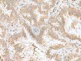 Immunohistochemistry of paraffin-embedded Human lung cancer tissue using CPLX3 Polyclonal Antibody at dilution of 1:55(×200)