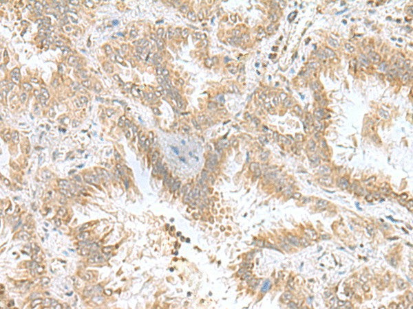 Immunohistochemistry of paraffin-embedded Human lung cancer tissue using CPLX3 Polyclonal Antibody at dilution of 1:55(×200)