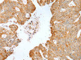 Immunohistochemistry of paraffin-embedded Human gastric cancer tissue using P2RY4 Polyclonal Antibody at dilution of 1:40(×200)