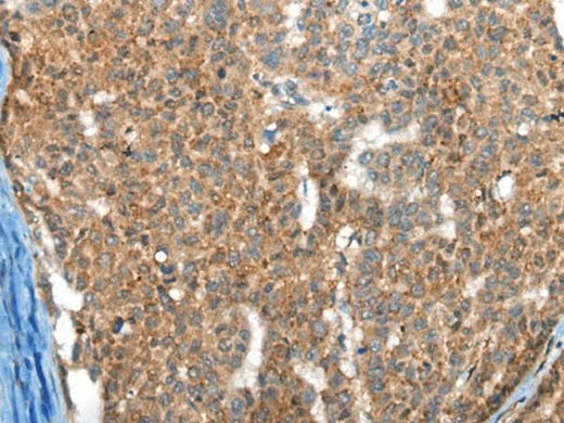 Immunohistochemistry of paraffin-embedded Human liver cancer tissue using FTL Polyclonal Antibody at dilution of 1:30(×200)