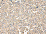 Immunohistochemistry of paraffin-embedded Human liver cancer tissue using C12orf40 Polyclonal Antibody at dilution of 1:50(×200)