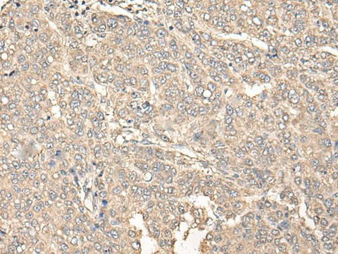 Immunohistochemistry of paraffin-embedded Human liver cancer tissue using C12orf40 Polyclonal Antibody at dilution of 1:50(×200)