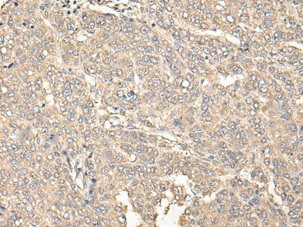 Immunohistochemistry of paraffin-embedded Human liver cancer tissue using C12orf40 Polyclonal Antibody at dilution of 1:50(×200)