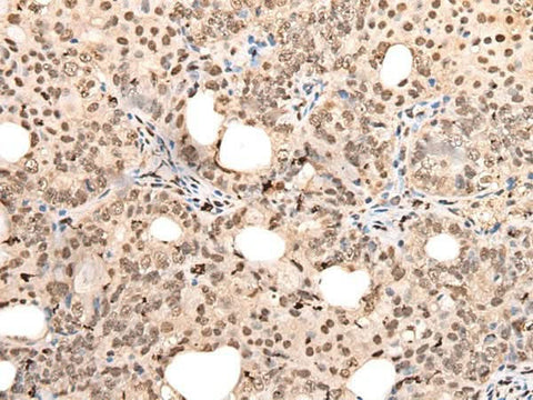 Immunohistochemistry of paraffin-embedded Human ovarian cancer tissue using ZSCAN12 Polyclonal Antibody at dilution of 1:40(×200)