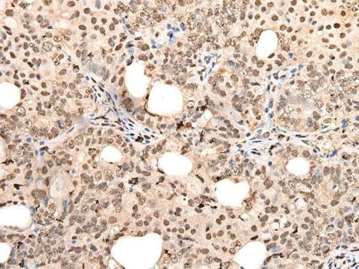 Immunohistochemistry of paraffin-embedded Human ovarian cancer tissue using ZSCAN12 Polyclonal Antibody at dilution of 1:40(×200)