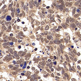 Immunohistochemistry analysis of paraffin-embedded human lung cancer using JUN Polyclonal Antibody at dilution of 1:500.