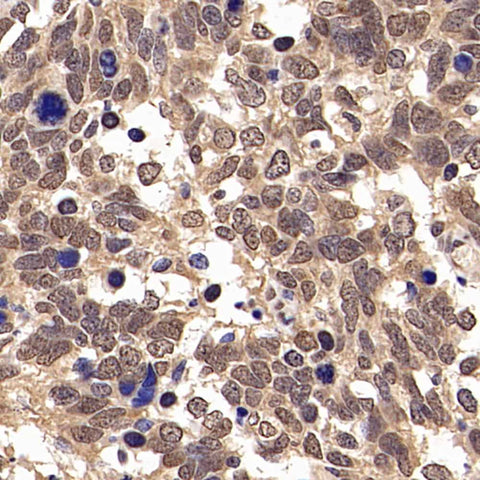 Immunohistochemistry analysis of paraffin-embedded human lung cancer using JUN Polyclonal Antibody at dilution of 1:500.