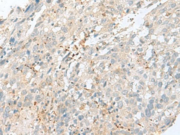 Immunohistochemistry of paraffin-embedded Human cervical cancer tissue using TPMT Polyclonal Antibody at dilution of 1:60(×200)