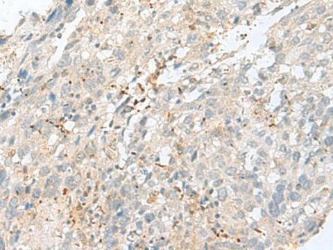 Immunohistochemistry of paraffin-embedded Human cervical cancer tissue using TPMT Polyclonal Antibody at dilution of 1:60(×200)