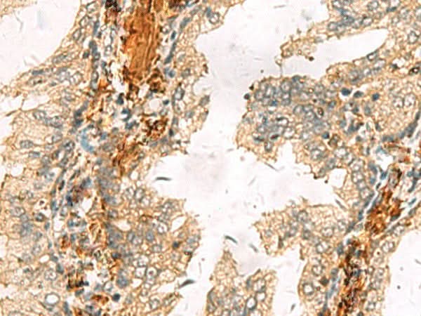 Immunohistochemistry of paraffin-embedded Human prost at e cancer tissue using ACTC1 Polyclonal Antibody at dilution of 1:65(×200)