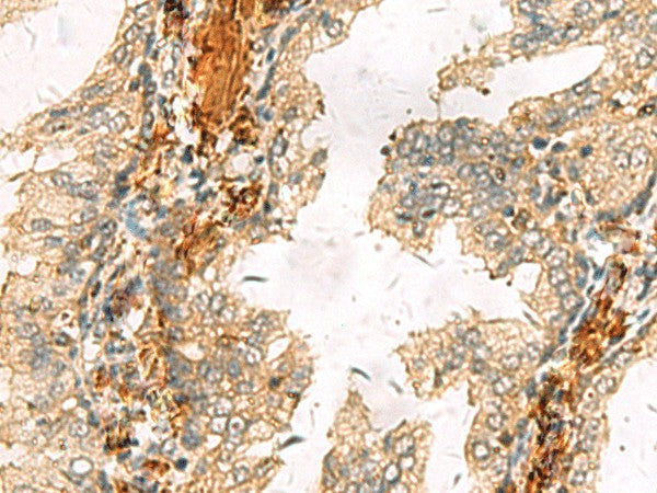Immunohistochemistry of paraffin-embedded Human prost at e cancer tissue using ACTC1 Polyclonal Antibody at dilution of 1:65(×200)