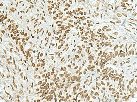 Immunohistochemistry of paraffin-embedded Human ovarian cancer tissue using HAS1 Polyclonal Antibody at dilution of 1:70(×200)