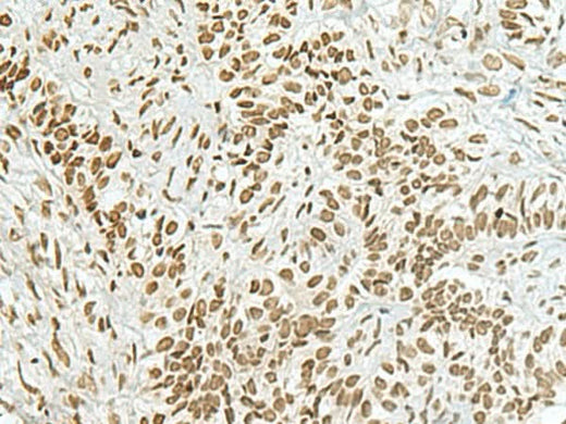 Immunohistochemistry of paraffin-embedded Human ovarian cancer tissue using HAS1 Polyclonal Antibody at dilution of 1:70(×200)