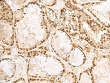 Immunohistochemistry of paraffin-embedded Human thyroid cancer tissue using KRR1 Polyclonal Antibody at dilution of 1:50(×200)
