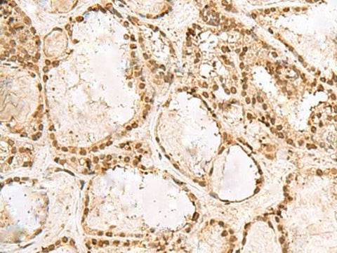 Immunohistochemistry of paraffin-embedded Human thyroid cancer tissue using KRR1 Polyclonal Antibody at dilution of 1:50(×200)