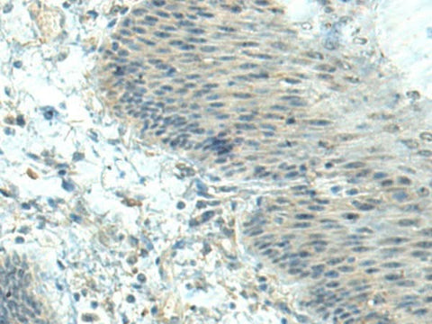 Immunohistochemistry of paraffin-embedded Human esophagus cancer tissue using CTDP1 Polyclonal Antibody at dilution of 1:70(×200)