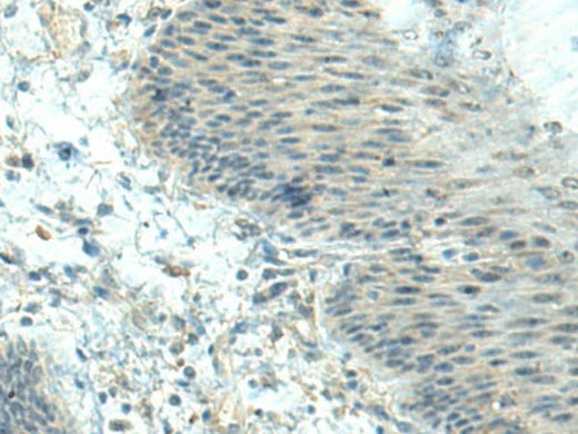 Immunohistochemistry of paraffin-embedded Human esophagus cancer tissue using CTDP1 Polyclonal Antibody at dilution of 1:70(×200)