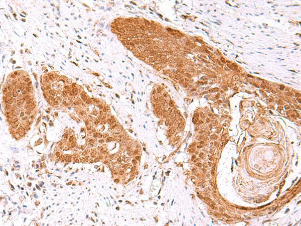 Immunohistochemistry of paraffin-embedded Human esophagus cancer tissue using FDPS Polyclonal Antibody at dilution of 1:60(×200)