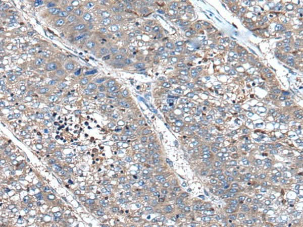 Immunohistochemistry of paraffin-embedded Human liver cancer tissue using XIRP1 Polyclonal Antibody at dilution of 1:90(×200)