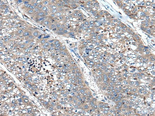 Immunohistochemistry of paraffin-embedded Human liver cancer tissue using XIRP1 Polyclonal Antibody at dilution of 1:90(×200)