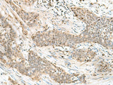 Immunohistochemistry of paraffin-embedded Human esophagus cancer tissue using LIG4 Polyclonal Antibody at dilution of 1:60(×200)