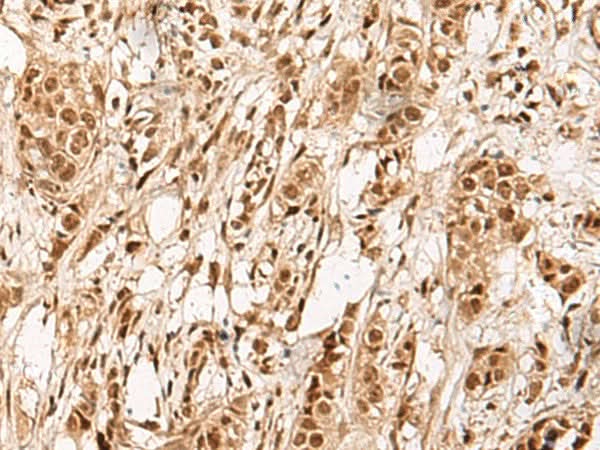 Immunohistochemistry of paraffin-embedded Human breast cancer tissue using ZBTB43 Polyclonal Antibody at dilution of 1:90(×200)