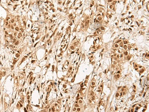 Immunohistochemistry of paraffin-embedded Human breast cancer tissue using ZBTB43 Polyclonal Antibody at dilution of 1:90(×200)