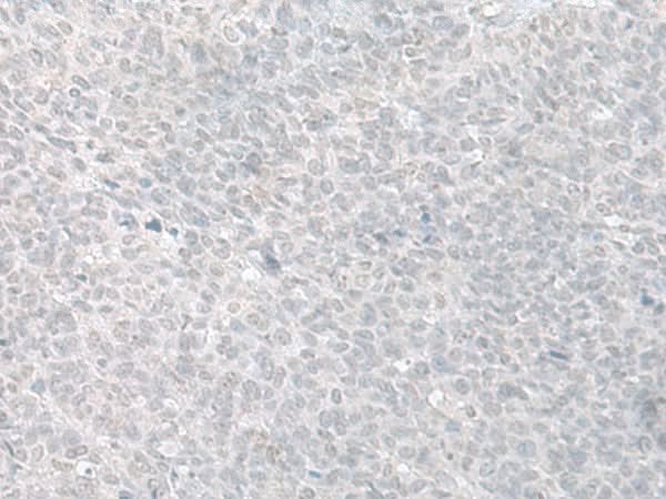 Immunohistochemistry of paraffin-embedded Human ovarian cancer tissue using C8orf4 Polyclonal Antibody at dilution of 1:70(×200)