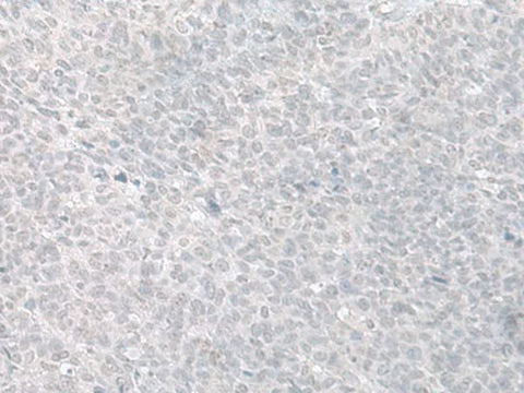 Immunohistochemistry of paraffin-embedded Human ovarian cancer tissue using C8orf4 Polyclonal Antibody at dilution of 1:70(×200)