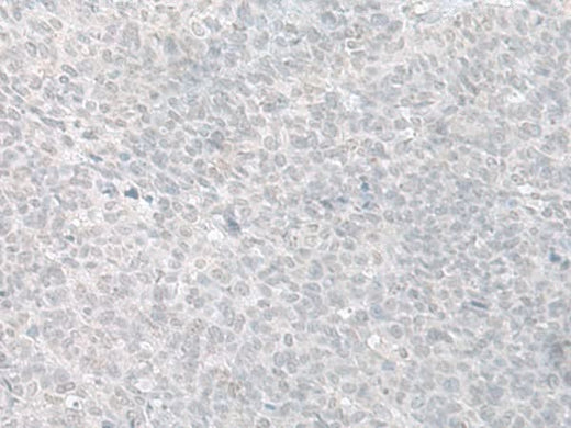 Immunohistochemistry of paraffin-embedded Human ovarian cancer tissue using C8orf4 Polyclonal Antibody at dilution of 1:70(×200)