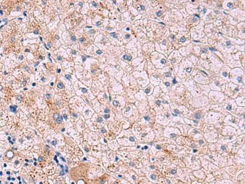 Immunohistochemistry of paraffin-embedded Human liver cancer tissue using JAM3 Polyclonal Antibody at dilution of 1:40(×200)