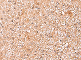 Immunohistochemistry of paraffin-embedded Human liver cancer tissue using ASTN2 Polyclonal Antibody at dilution of 1:80(×200)