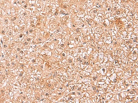 Immunohistochemistry of paraffin-embedded Human liver cancer tissue using ASTN2 Polyclonal Antibody at dilution of 1:80(×200)