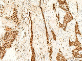 Immunohistochemistry of paraffin-embedded Human esophagus cancer tissue using METTL1 Polyclonal Antibody at dilution of 1:55(×200)