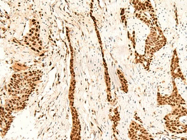 Immunohistochemistry of paraffin-embedded Human esophagus cancer tissue using METTL1 Polyclonal Antibody at dilution of 1:55(×200)