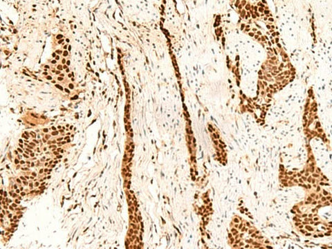 Immunohistochemistry of paraffin-embedded Human esophagus cancer tissue using METTL1 Polyclonal Antibody at dilution of 1:55(×200)