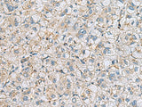 Immunohistochemistry of paraffin-embedded Human liver cancer tissue using MTHFD2 Polyclonal Antibody at dilution of 1:65(×200)