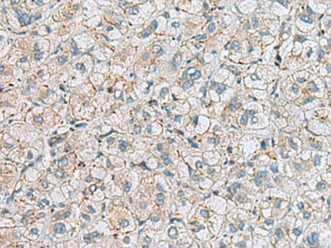 Immunohistochemistry of paraffin-embedded Human liver cancer tissue using MTHFD2 Polyclonal Antibody at dilution of 1:65(×200)