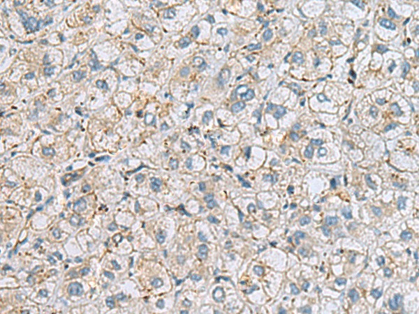 Immunohistochemistry of paraffin-embedded Human liver cancer tissue using MTHFD2 Polyclonal Antibody at dilution of 1:65(×200)