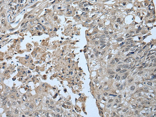 Immunohistochemistry of paraffin-embedded Human lung cancer tissue using UBR2 Polyclonal Antibody at dilution of 1:55(×200)