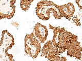 Immunohistochemistry of paraffin-embedded Human thyroid cancer tissue using GFI1B Polyclonal Antibody at dilution of 1:40(×200)