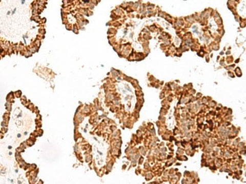 Immunohistochemistry of paraffin-embedded Human thyroid cancer tissue using GFI1B Polyclonal Antibody at dilution of 1:40(×200)