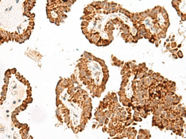 Immunohistochemistry of paraffin-embedded Human thyroid cancer tissue using GFI1B Polyclonal Antibody at dilution of 1:40(×200)