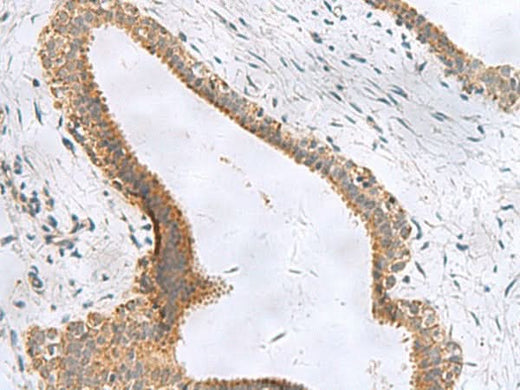 Immunohistochemistry of paraffin-embedded Human breast cancer tissue using CEMIP Polyclonal Antibody at dilution of 1:120(×200)