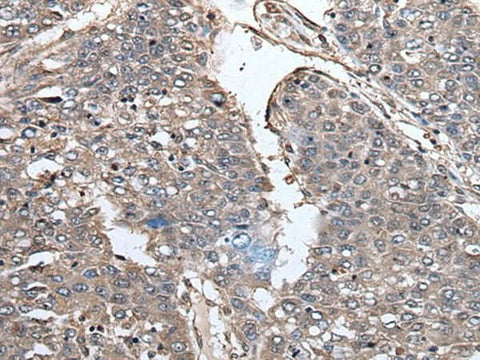Immunohistochemistry of paraffin-embedded Human liver cancer tissue using PRUNE Polyclonal Antibody at dilution of 1:40(×200)