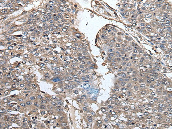 Immunohistochemistry of paraffin-embedded Human liver cancer tissue using PRUNE Polyclonal Antibody at dilution of 1:40(×200)