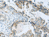 Immunohistochemistry of paraffin-embedded Human cervical cancer tissue using RMDN2 Polyclonal Antibody at dilution of 1:70(×200)