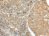 Immunohistochemistry of paraffin-embedded Human cervical cancer tissue using STT3A Polyclonal Antibody at dilution of 1:70(×200)